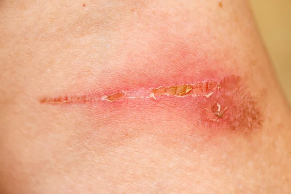 Detalhe da cicatriz de queimadura — Fotografia de Stock