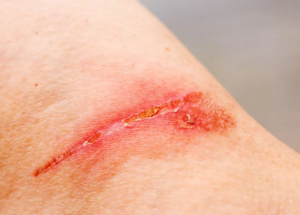 Cicatriz de queimadura — Fotografia de Stock