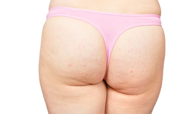 Cellulite — Foto Stock