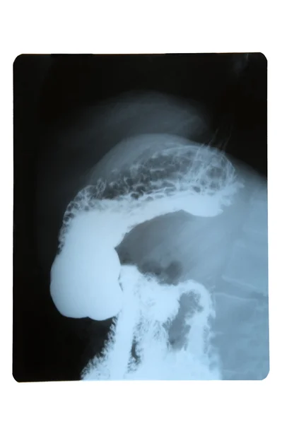 X ray of stomach — Stock Photo, Image