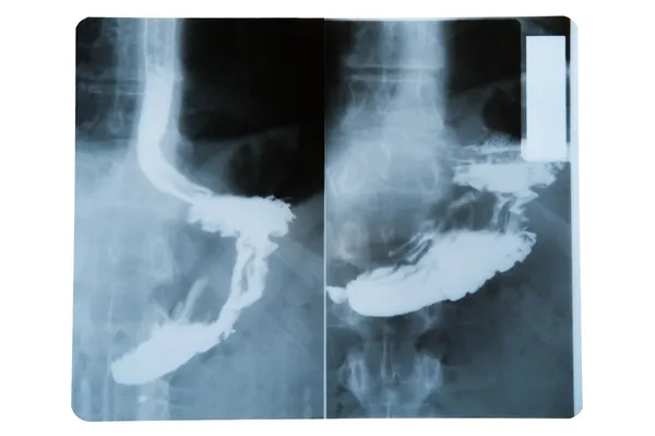 胃在白色的 x 射线图像 — 图库照片