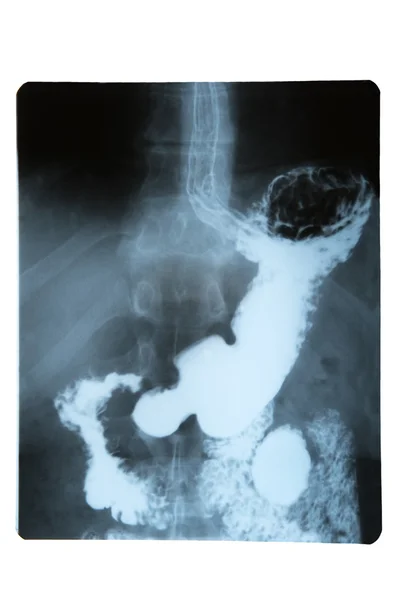 X 射线的胃 — 图库照片