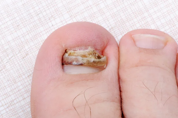 Broken ill nail on leg — Stock Photo, Image