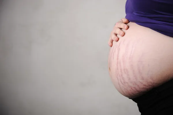 Femme enceinte avec un estomac très naturel - fissures sur la peau — Photo