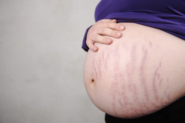 Pregnant woman with natural stomach - cracks on skin — Stock Photo, Image