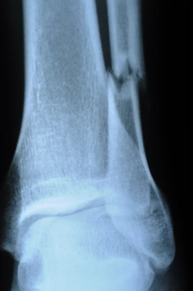 stock image X-ray of broken human leg