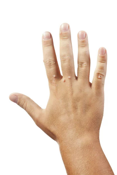 Mão com verrugas isoladas no fundo branco — Fotografia de Stock