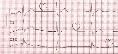EKG kalp