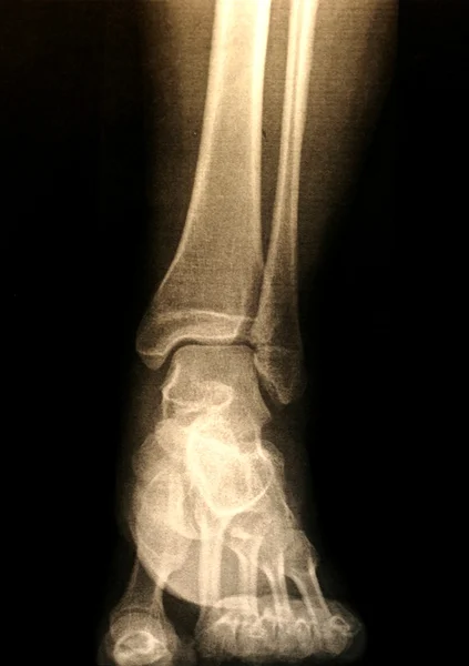 stock image X-ray of a foot