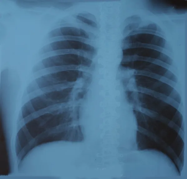 Menschliche Lungen — Stockfoto
