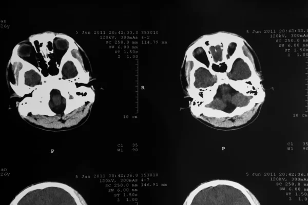MRI tomogram of human brain — Stock Photo, Image