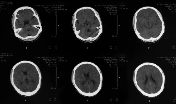 MRI tomogram of human brain — Stock Photo, Image