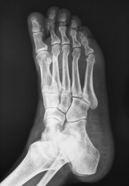 Injured foot X piece of figure — Stock Photo, Image