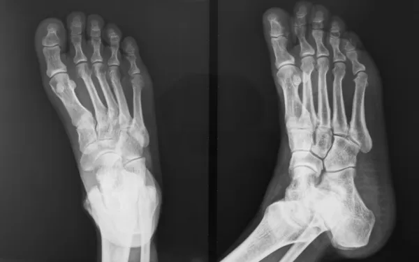 O pé ferido da figura de raio-X — Fotografia de Stock