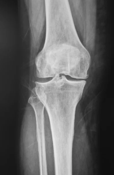 Collection of x-ray normal knee — Stock Photo, Image