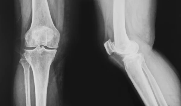 stock image Collection of x-ray normal knee