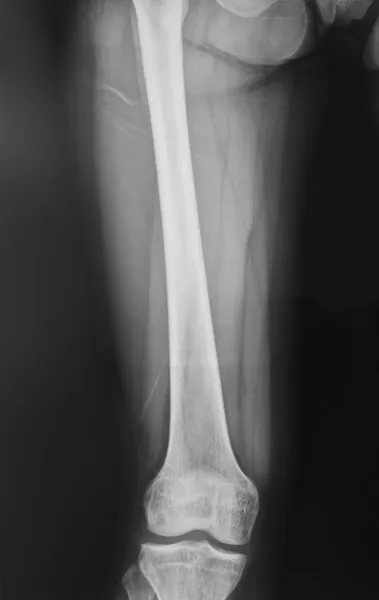 Сбор рентгеновского нормального колена — стоковое фото
