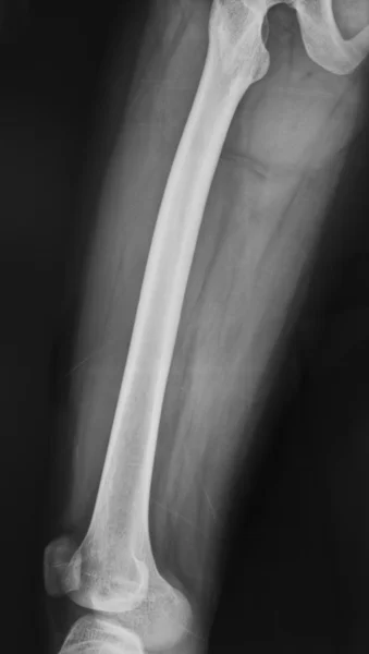 Coleta de raio-x joelho normal — Fotografia de Stock