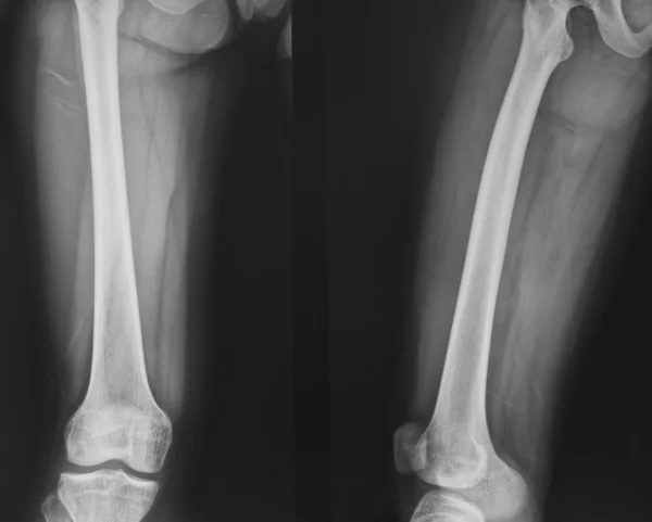 Сбор рентгеновского нормального колена — стоковое фото