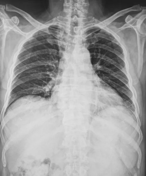 Рентгеновский снимок человеческой груди — стоковое фото