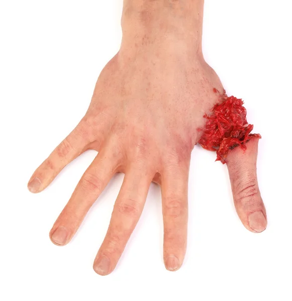 Mão humana artificial com dedo cortado — Fotografia de Stock