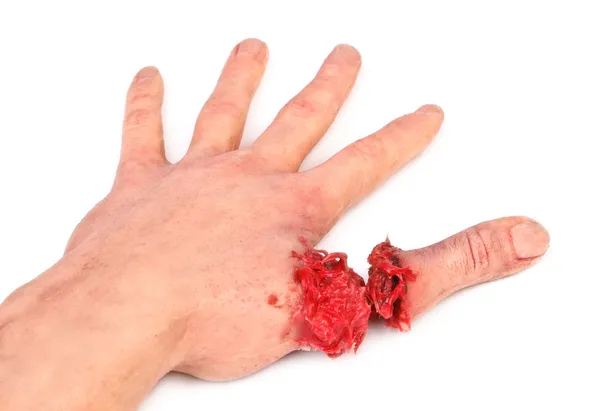 Mão humana artificial com dedo cortado — Fotografia de Stock