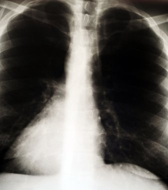 x-ray görüntü