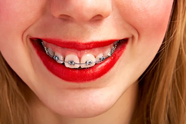 stock image Woman with brackets