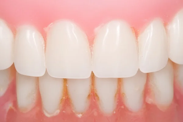 Зубний протез — стокове фото