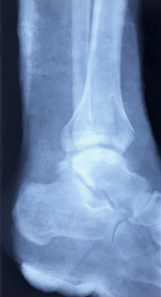 Imagen de rayos X del pie humano —  Fotos de Stock