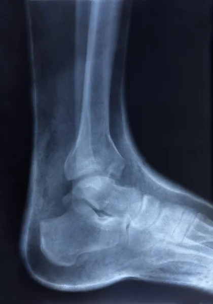 Zdjęcie rentgenowskie ludzkiej stopy — Zdjęcie stockowe