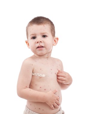 Little boy whit smallpox clipart