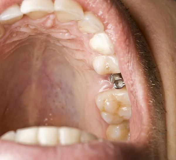 Имплантат стоматологии — стоковое фото