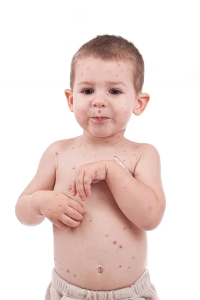 Malý chlapec drobet neštovice — Stock fotografie