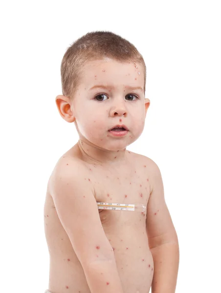Little boy whit smallpox — Stock Photo, Image