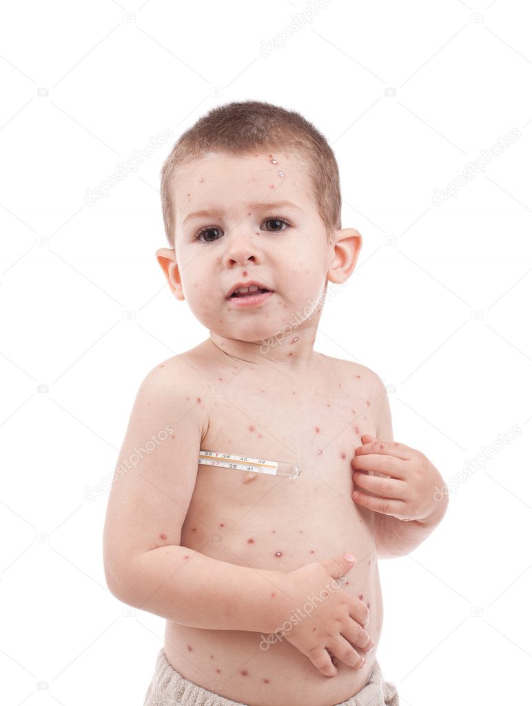 Little boy whit smallpox