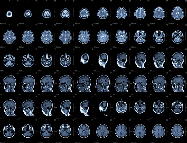Head MRI — Stock Photo, Image