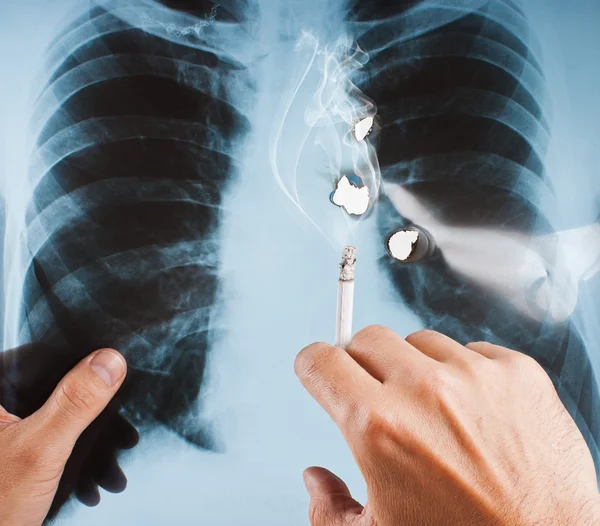 stock image X-ray lung