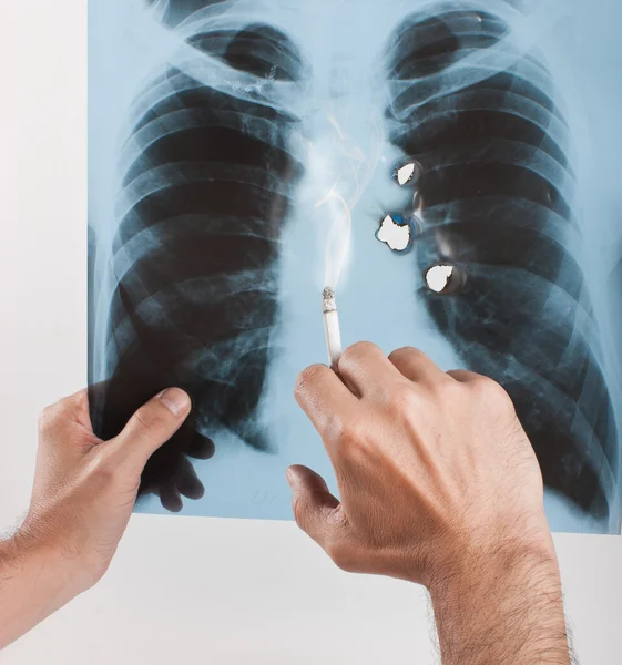 X-레이 폐 — 스톡 사진