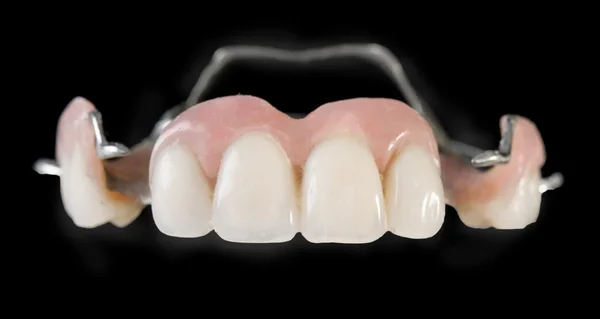 Diş implantları — Stok fotoğraf