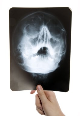 Kafatası röntgen fotoğraf