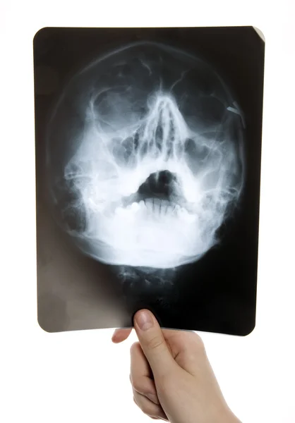 Röntgenbild des Schädels — Stockfoto