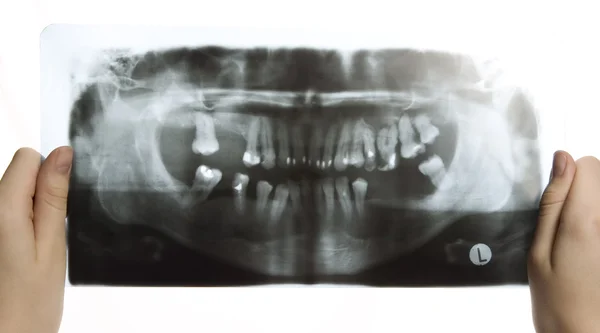 Roentgen photo of teeth — Stock Photo, Image
