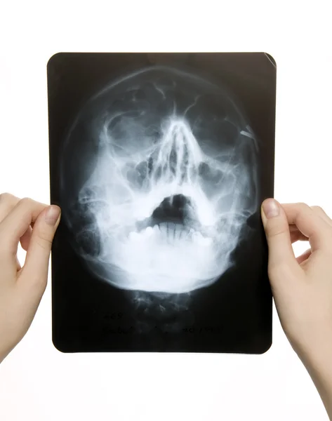 Röntgen foto av skalle — Stockfoto