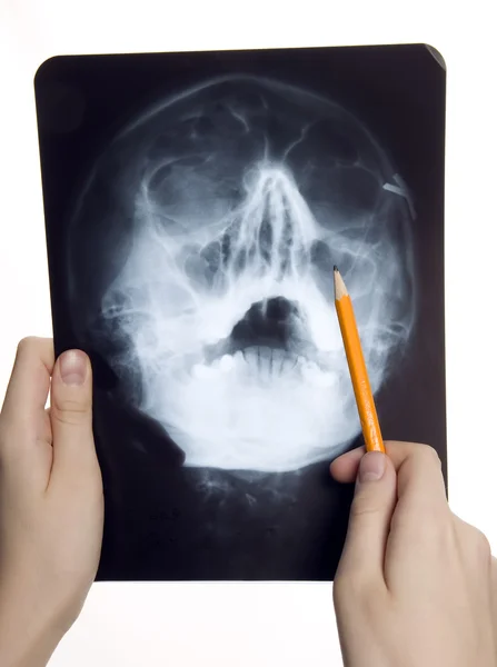 Roentgen photo of skull — Stock Photo, Image