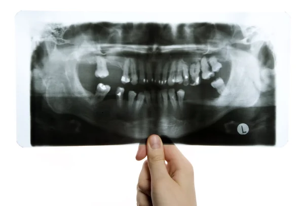 Rentgenovým fotografie zubů — Stock fotografie