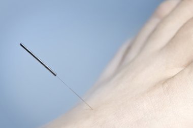 Acupuncture needle in foot clipart