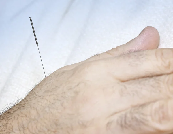 Akupunkturní jehlou v ruce — Stock fotografie