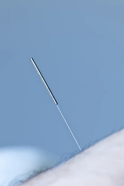 Aiguille d'acupuncture dans la peau — Photo