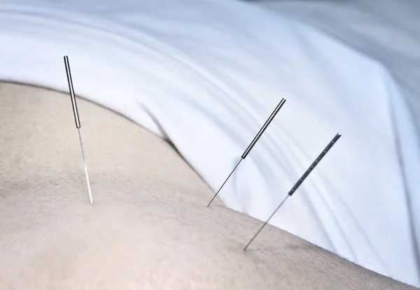 stock image Acupuncture needles in shoulder